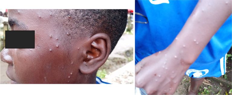 MEASLES_COVACC_V2